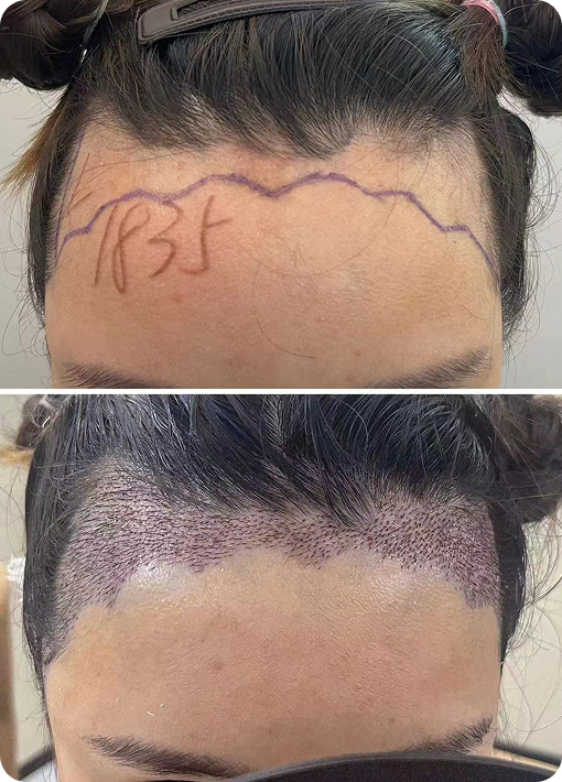 Beard restoration before and after result AF